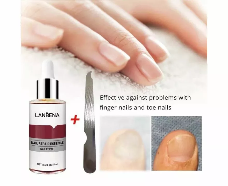 Butenafine for Nail Fungus: Is It the Right Treatment for You?