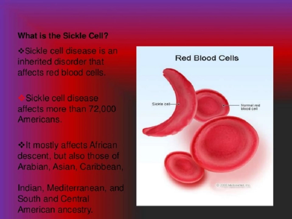 Sickle Cell Anemia and Dental Health: Protecting Your Smile